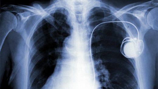 Big news for pacemakers vulnerable to hacks